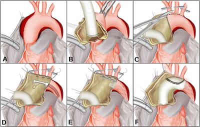 En Bloc Arch Reconstruction With the Frozen Elephant Trunk Technique for Acute Type a Aortic Dissection